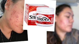 ONE MONTH USING STRIDEX PADS FOR MY ACNE [upl. by Eido]