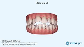 Invisalign Clincheck [upl. by Akirderf]