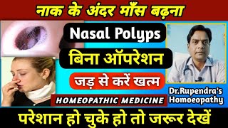 नाक के अंदर माँस बढ़ना। Nasal Polyps Treatment Without Surgery। Nasal Polyps Homeopathic Medicine। [upl. by Reppep]