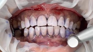 Dental scaling ASMR  plaque staining [upl. by Eznyl]