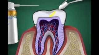 was ist eine Zahnnerventzündung  Pulpitis [upl. by Eimerej]