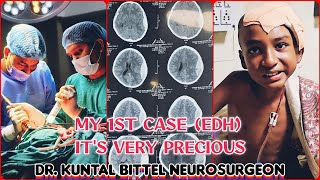 1st Case As NeuroSurgery Resident  Its Precious  Extradural Haemorrhage  EDH  Complete Recovery [upl. by Ritz]