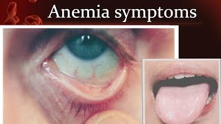 Anemia symptoms [upl. by Leibrag]