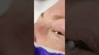 Eye Wrinkles Treatment with Ablative Co2 Laser [upl. by Decrem]