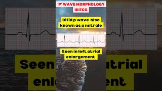 Morphology of p wave in ecg learnecg [upl. by Saxen]