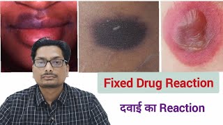 दवाई का Reaction  Fixed Drug Reaction  Paracetamol Ciprofloxacin Metronidazole Ornidazole PCM [upl. by Tadio]