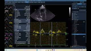 IQ 172 TV MEASUREMENT ECHOCARDIOGRAPHY ECHOPAC ANALYSIS WEAKNESS [upl. by Friedland595]