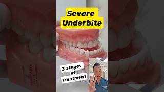 Underbite Treatment Demystified The 3 Essential Stages shorts dentallan dentist [upl. by Abran6]