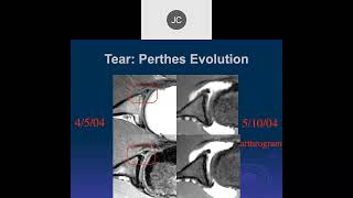 MRI of the Shoulder 2023 – Anterior Labral Tears Part 2 [upl. by Ellary]