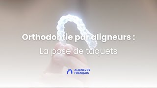 Orthodontie invisible par aligneurs  la pose de taquets [upl. by Innus]