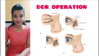 Dacryocystorhinostomy DCRsurgery Dacryocystitis Part 2 A K Khurana [upl. by Attelra]