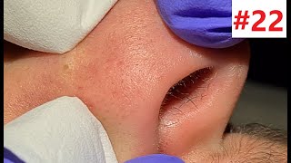 BLACKHEADS EXTRACTIONS on Happys Nose [upl. by Sandry]