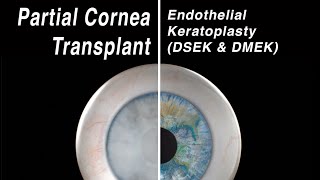 Selective Cornea Transplant  Endothelial Keratoplasty DMEK DSEK [upl. by Eatton]