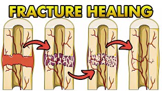 Fracture Healing  ANIMATION  BASICS  The Young Orthopod [upl. by Derfniw]