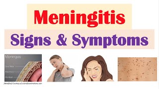 Meningitis Signs and Symptoms amp Why They Occur [upl. by Kayley]