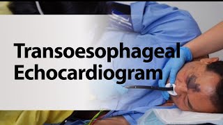 Transoesophageal Echocardiogram [upl. by Dareece259]