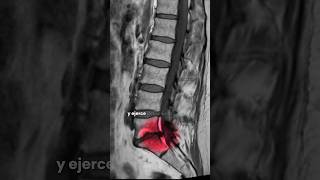 ¿Sufres de Lumbalgia salud quiropráctico lumbar lumbarspine dolordeespalda chiropractor [upl. by Siroval665]