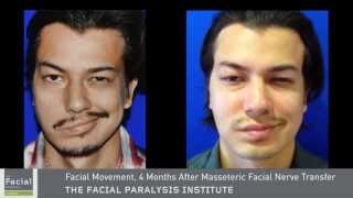 Masseter To Facial Nerve Surgery  Facial Paralysis Expert Dr Azizzadeh [upl. by Zaneski]