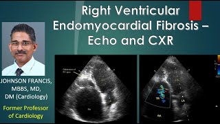 Right Ventricular Endomyocardial Fibrosis – Echo and CXR [upl. by Novart]