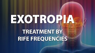 Exotropia  RIFE Frequencies Treatment  Energy amp Quantum Medicine with Bioresonance [upl. by Bausch]