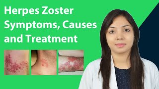 Herpes Zoster  Causes Symptoms in Men amp Women  Herpes Zoster Diagnosis amp Treatment HerpesZoster [upl. by Killoran]