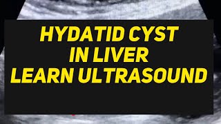 Hydatid Cyst in Liver ultrasound case  learn usg [upl. by Holtorf]