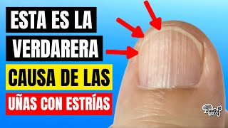 🔴 ¿Porque tengo UÑAS con ESTRÍAS ¡Esta es la verdadera CAUSA Tu cuerpo te HABLA [upl. by Ebenezer860]