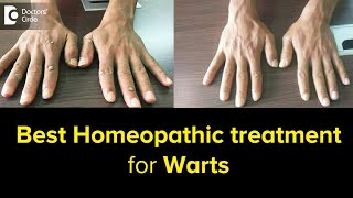 Best Homeopathic Treatment of Warts  Before amp After TreatmentDrVBhagyalakshmi  Doctors Circle [upl. by Kruter]