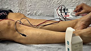 Electro Acupuncture  Needle Therapy  electroacupuncture acupuncture [upl. by Erika]