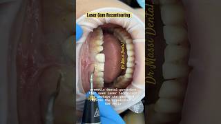 Laser Gum Recontouring oralhealth youtubeshorts dentist smile gummy gummysmile shorts [upl. by Ivor900]