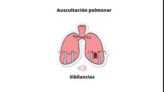 Ruidos respiratorios agregados  Sibilancias [upl. by Corry]