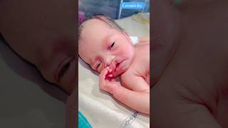 Newborn Cleft Lipmedical newbornbaby viralvideo [upl. by Humfrey]