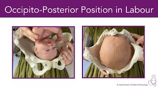 OccipitoPosterior Position BacktoBack in Labour [upl. by Hoj346]