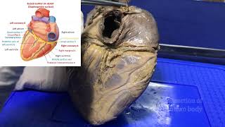 Blood supply of heart or Coronary circulation  Gross and clinical anatomy [upl. by Ariaic664]