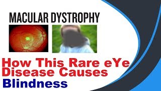 Macular Dystrophy hindi [upl. by Sarine]