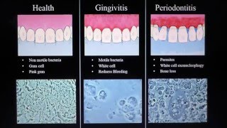 Health Gingivitis Periodontitis Mark Bonner dmd [upl. by Sihunn892]