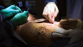 Woman Covered in Tumors Undergoes Surgery [upl. by Eleahcim]