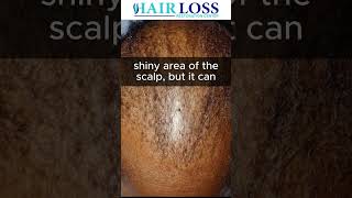 Types of Alopecia What is CCCA [upl. by Woll]