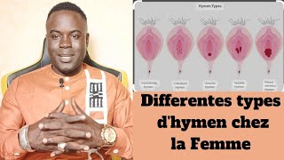 Différents types dhymen chez la femme [upl. by Eynobe845]