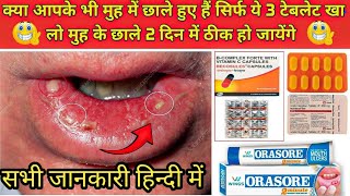 सिर्फ ये टेबलेट खा लो मुह के छाले 1 दिन मेें ठीक हो जायेंगे  Stomatitis Treatment in hindi  Ulcer [upl. by Bremble]