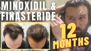 Minoxidil amp Finasteride  12 Month Update  Christopher Painter [upl. by Neelia732]