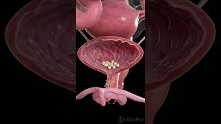 🪨 Bladder Stones What You Need to Know 🪨 anatomy [upl. by Sherilyn]