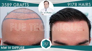 Hair Graft Technique FUE 3589 Grafts 9178 Hairs  Dr de Freitas [upl. by Tandie]