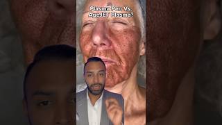 Plasma Fibroblast Vs AgeJet Plasma Which One Dr Somji Explains [upl. by Ayila]