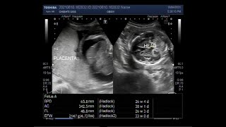 Hydrops fetalis with Soft tissue edema Cardiomegaly Pericardial effusion and ascites [upl. by Nac]