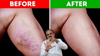 No Tablet  No Surgery  Treat Your Varicose Veins problem Without Any Surgery  Doctor Shiva [upl. by Darn338]