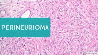 PerineuriomaExplained by a Soft Tissue Pathologist [upl. by Demona]