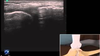 How To Ultrasound Exam of the Medial Collateral Ligament 3D Video [upl. by Alrak]