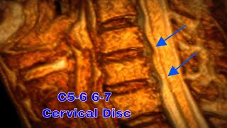 3D MRI로 보는 C56 C67 경추 디스크 이해하기 Understanding C56 C67 Cervical Disc Herniation in 3D MRI [upl. by Jueta390]