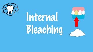 Internal Whitening Protocols Pt1 Non Vital Bleaching  PDP146 [upl. by Aicarg]